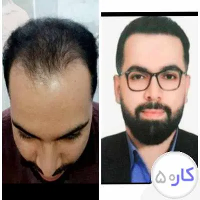 به مناسبت جشنواره مدل کاشت مو قبول می کنیم