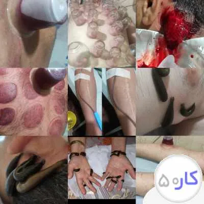 خدمات حجامت بادکش وزالودرمانی فصد خون وخدمات پرستاری