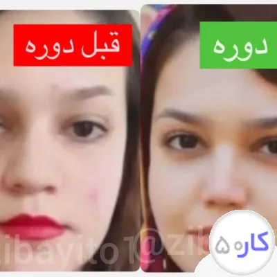لیفت بینی