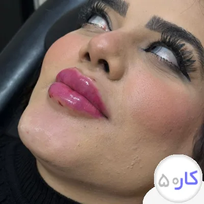 تزریق ژل وبوتاکس در کلینیک