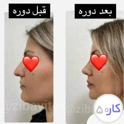 لیفت بینی