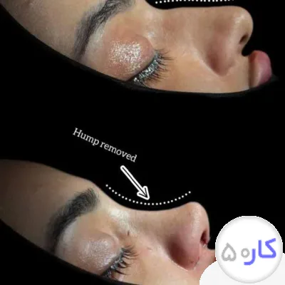 عکس آگهی عمل بینی ۲۸م بدون تامپون، لیپو، بلفاروپلاستی، لیفت