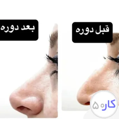 لیفت بینی