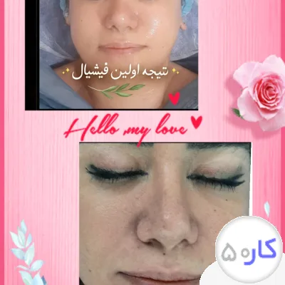 عکس آگهی فشیال کار ،پاکسازی پوست
