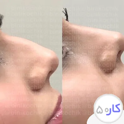 لیفت بینی