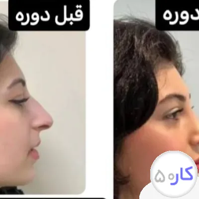 لیفت بینی