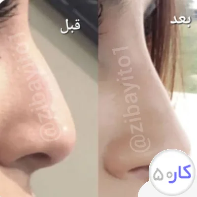 لیفت بینی