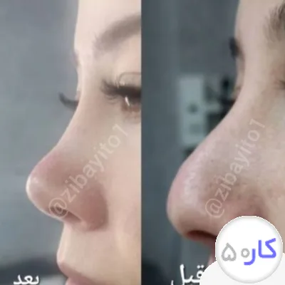 لیفت بینی
