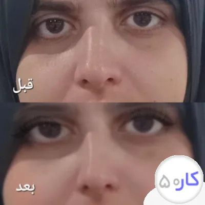 لیفت بینی