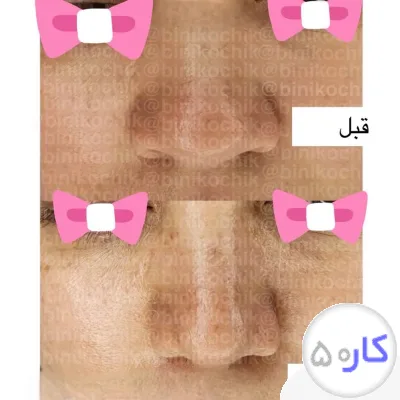 لیفت بینی