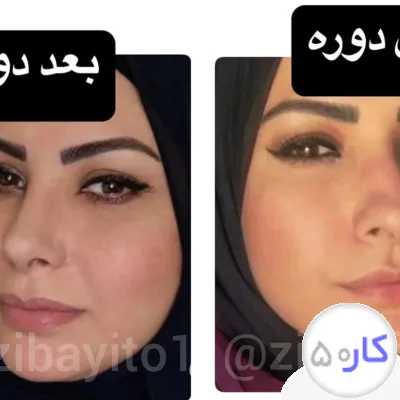 عکس آگهی لیفت بینی